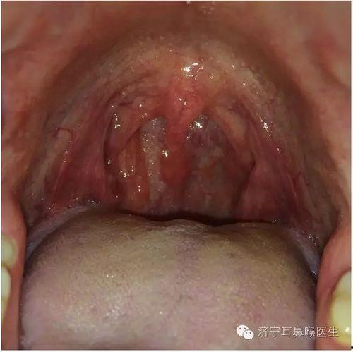 咽炎吃瓜之后严重咳嗽,警惕饮食与病症的微妙关系